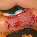 Skin Graft for Shark Attack to Leg Skin Graft for Shark Attack to Leg