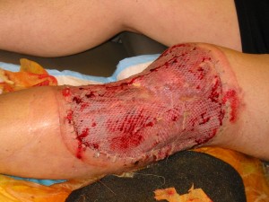 skin graph to leg bite enlarged 300x225 Teenage Girl Mauled in Florida Shark Attack