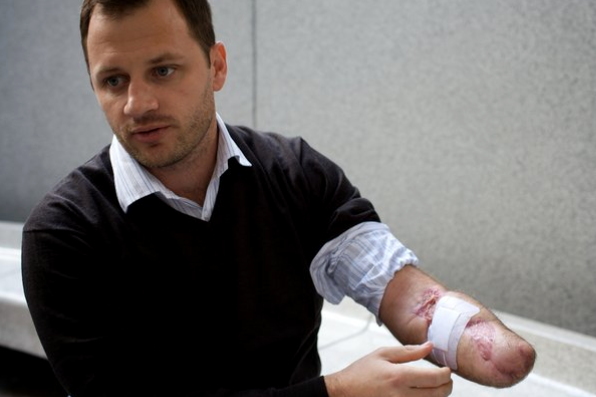 Glenn Orgias lost a hand after he was bitten by a great white shark while surfing at Bondi Beach. 